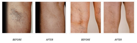 venorex before and after testimonials
